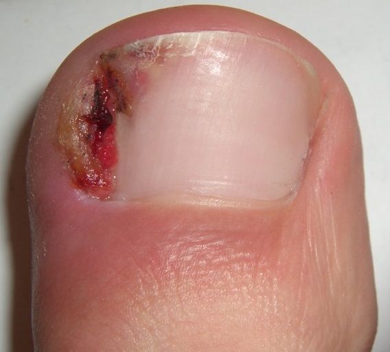 A Person is Getting Their Toenails Painted by a Nail Artist — Maitland Central Podiatry in Maitland NSW