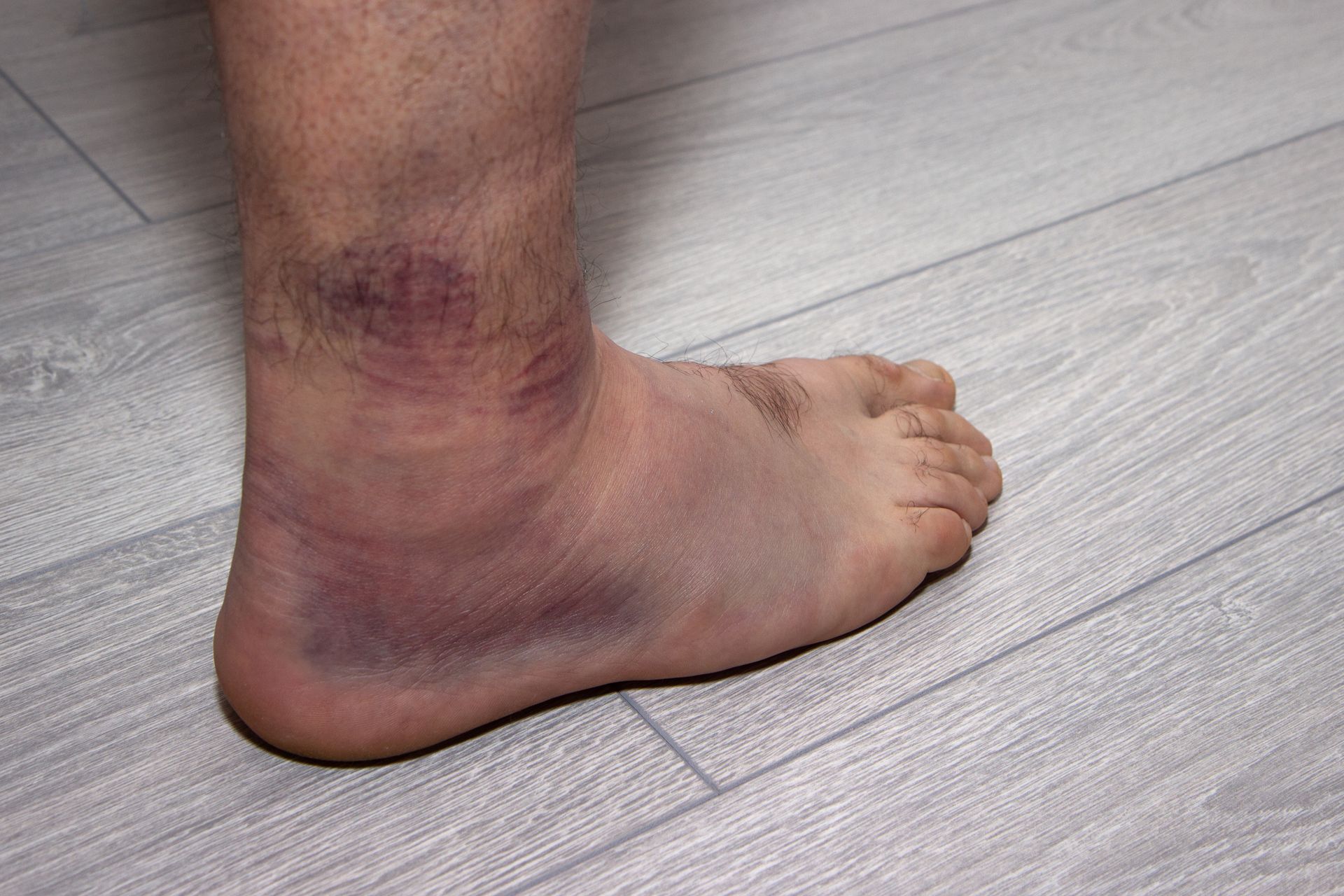 ankle fractures