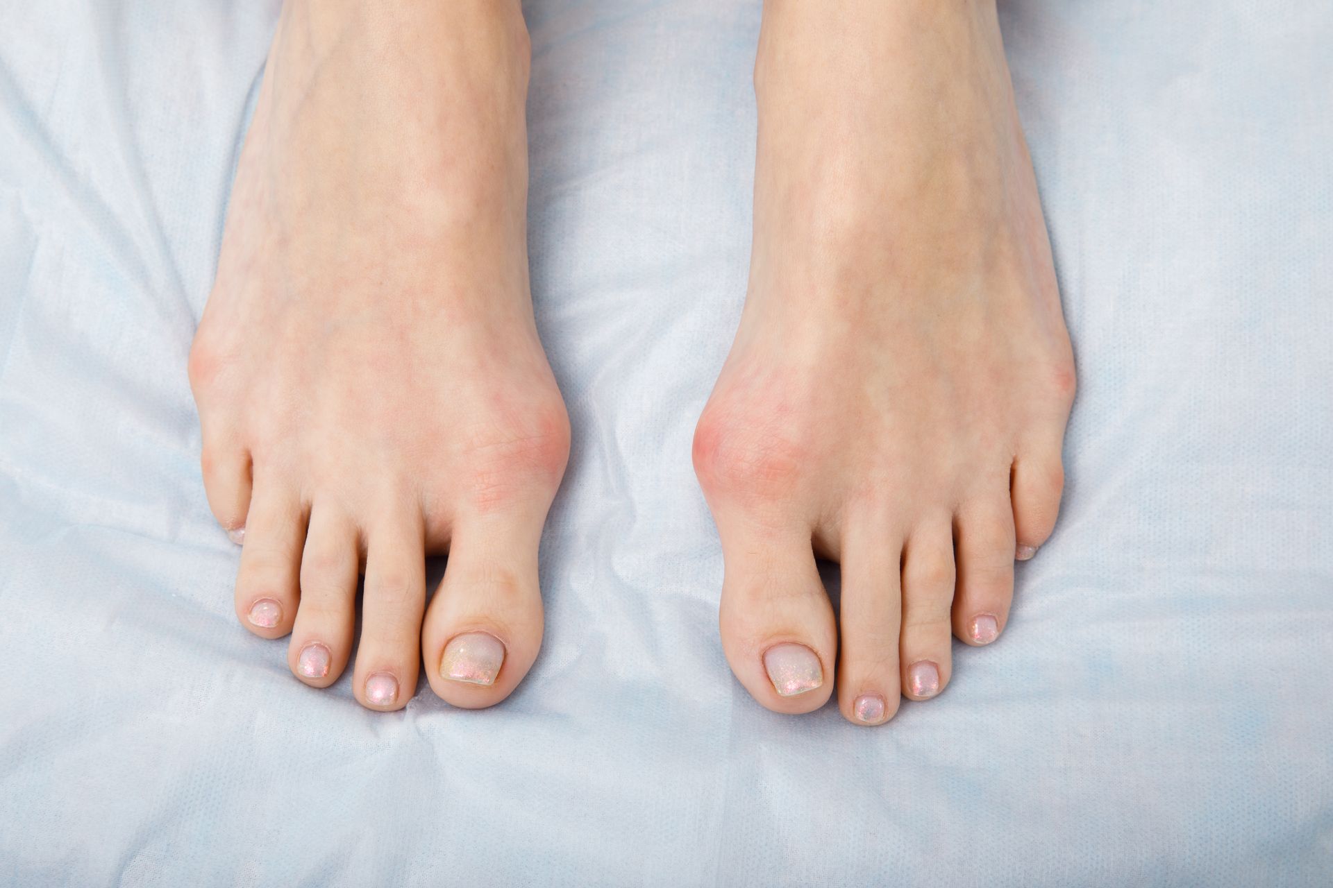 Bunion Development on feet