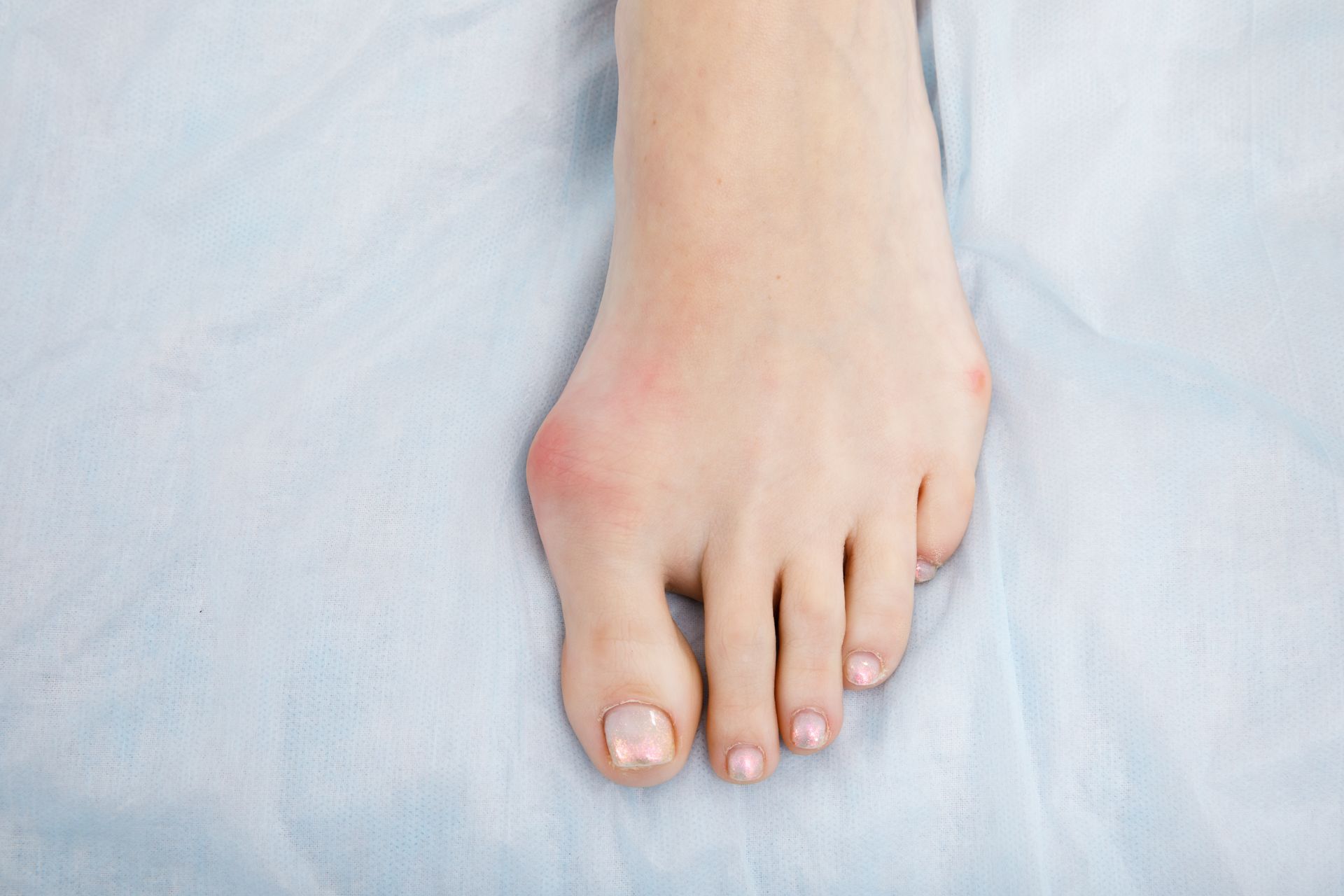 Bunion Surgery