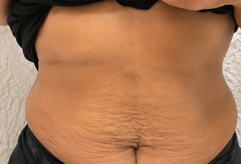 Close-up of a bare abdomen with visible skin folds and stretch marks against a light background