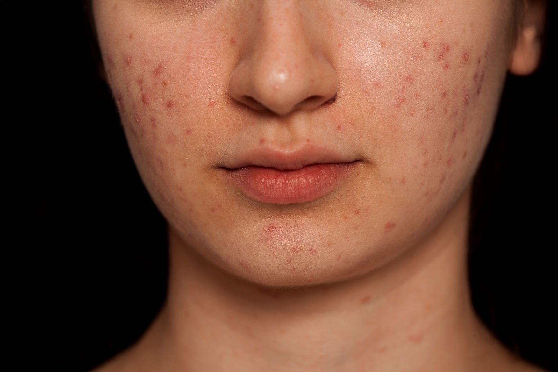 pelle con acne