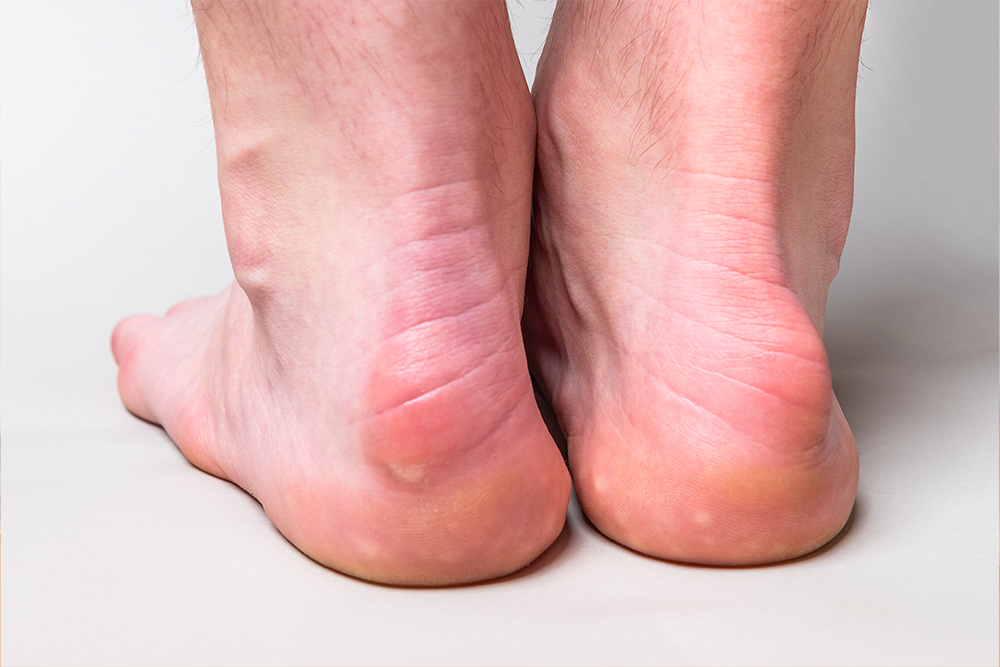 Haglund's Deformity