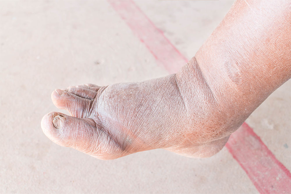 Ischemic Foot
