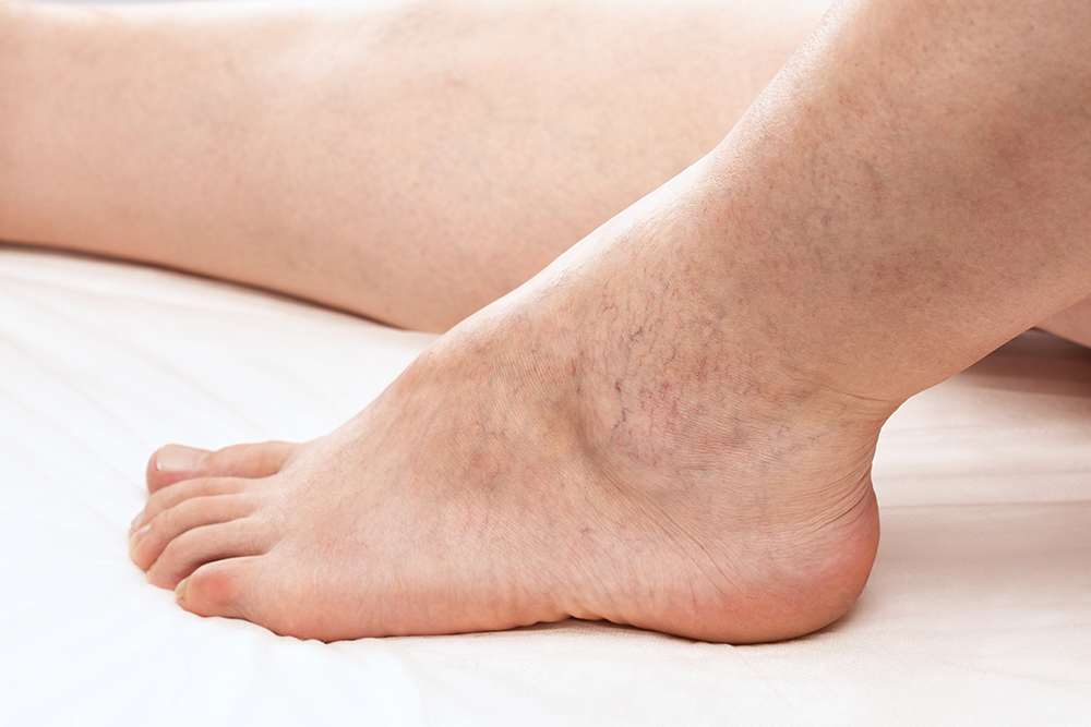 Venous Stasis