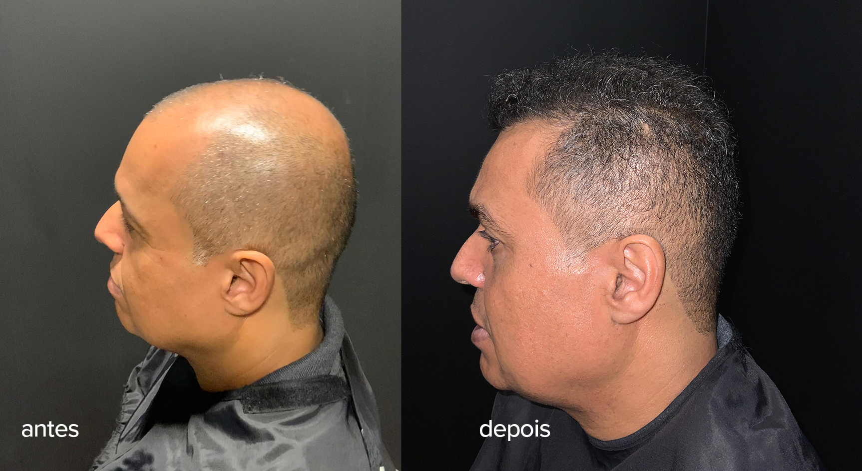 A before and after photo of a man with a bald head.