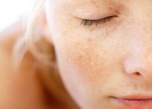 Manchas na pele: melasma