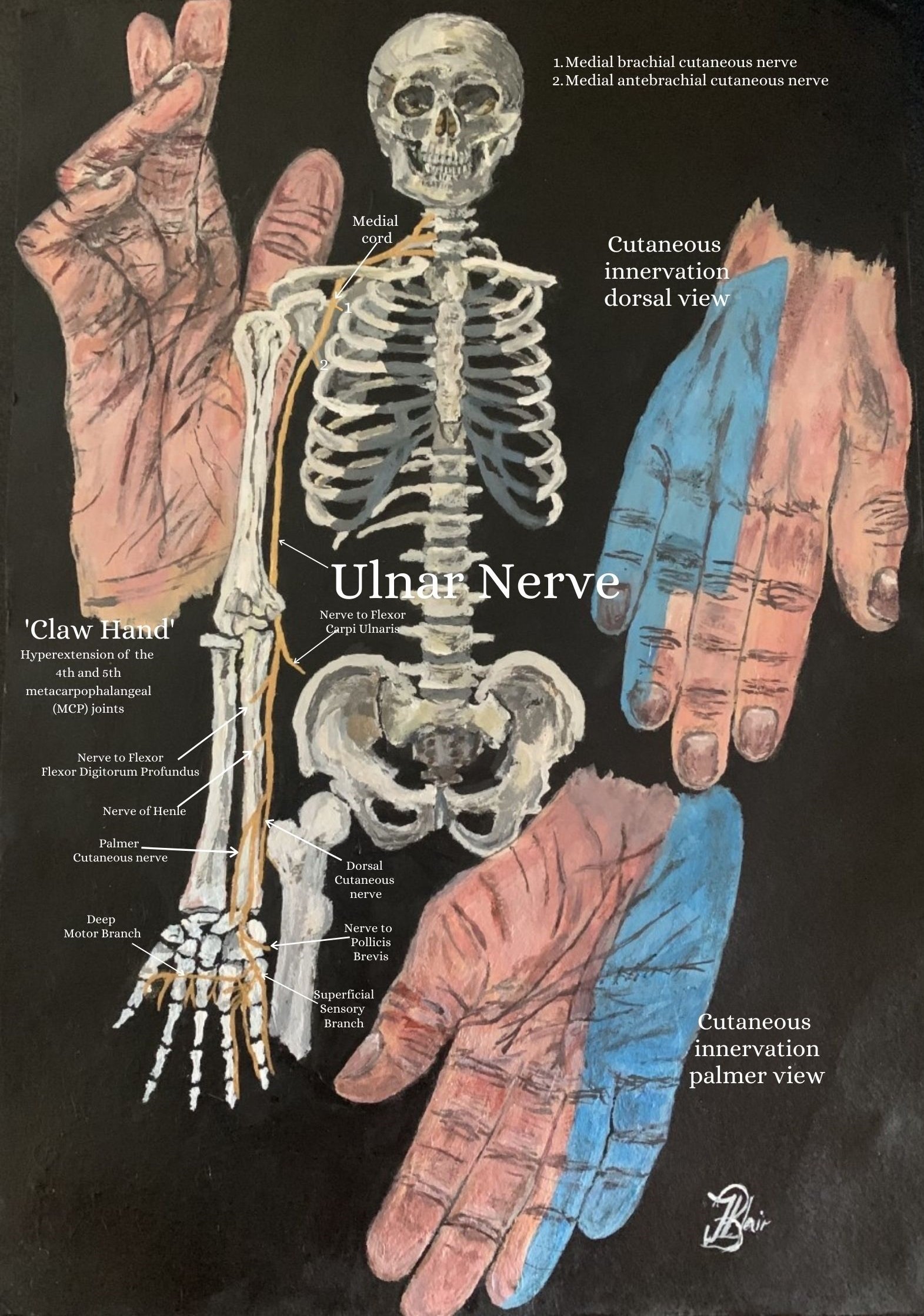 Injury and Neuropathy of the Ulnar Nerve