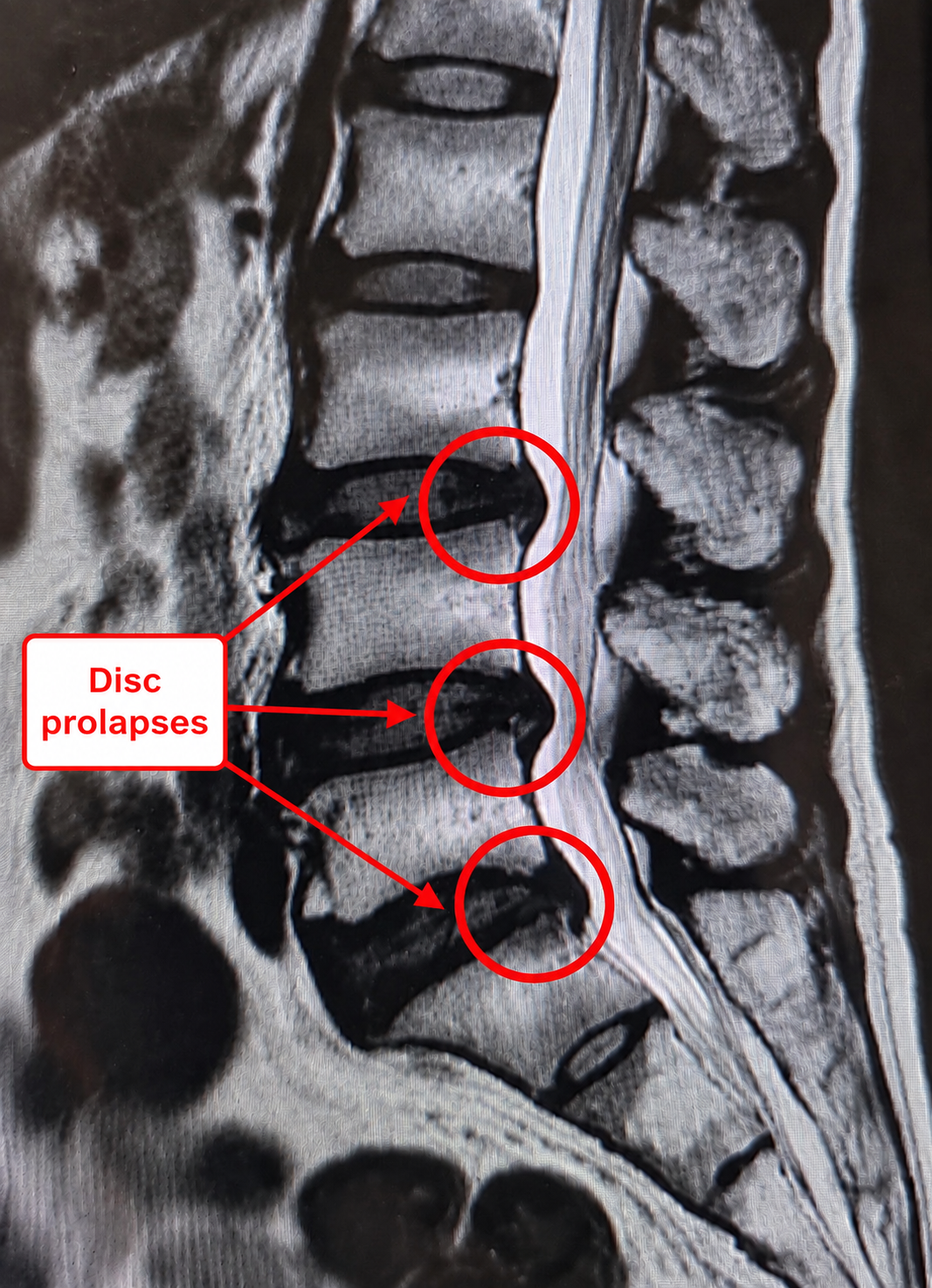 Prolapse disc