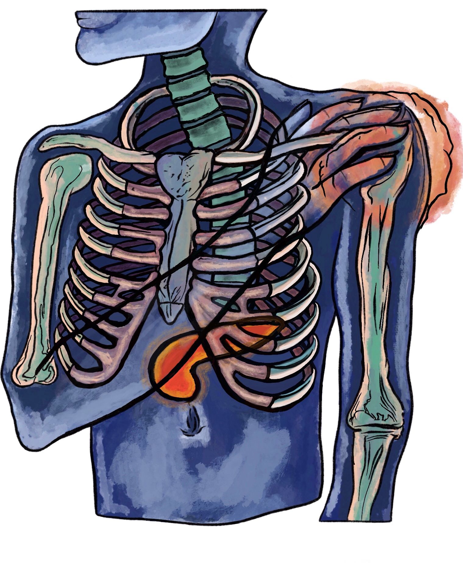 Frozen shoulder pain caused by pathology of the pancreas
