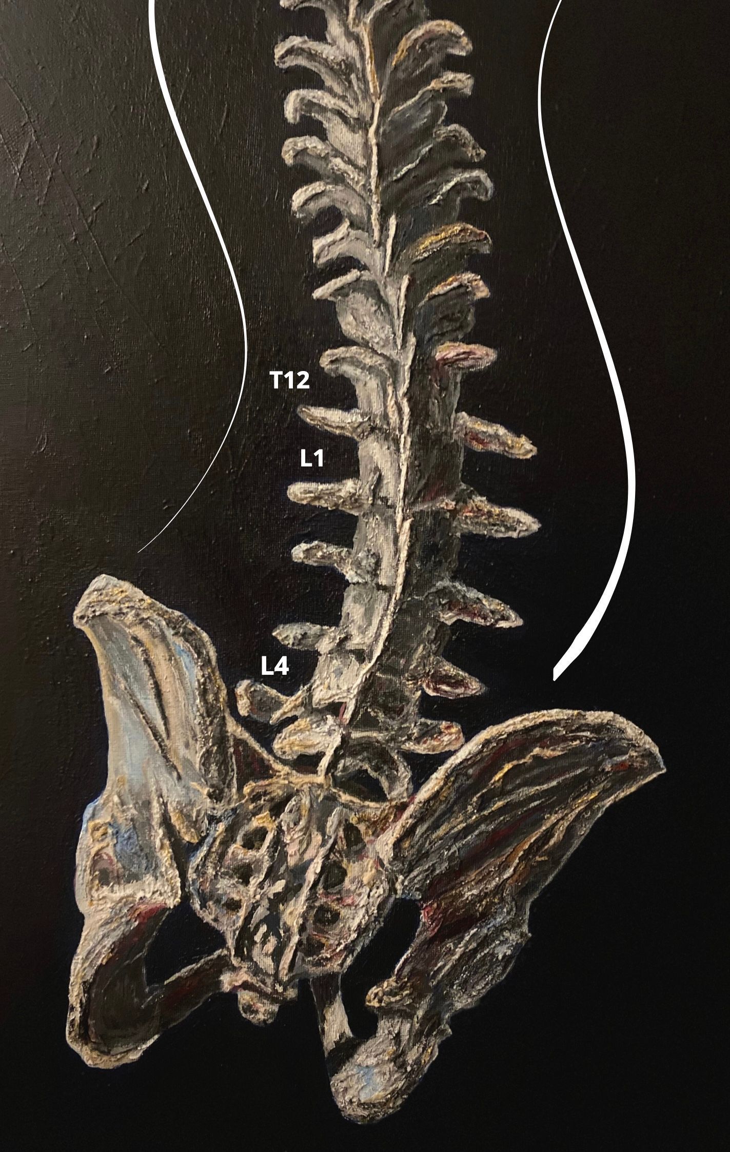Scoliosis of the spine