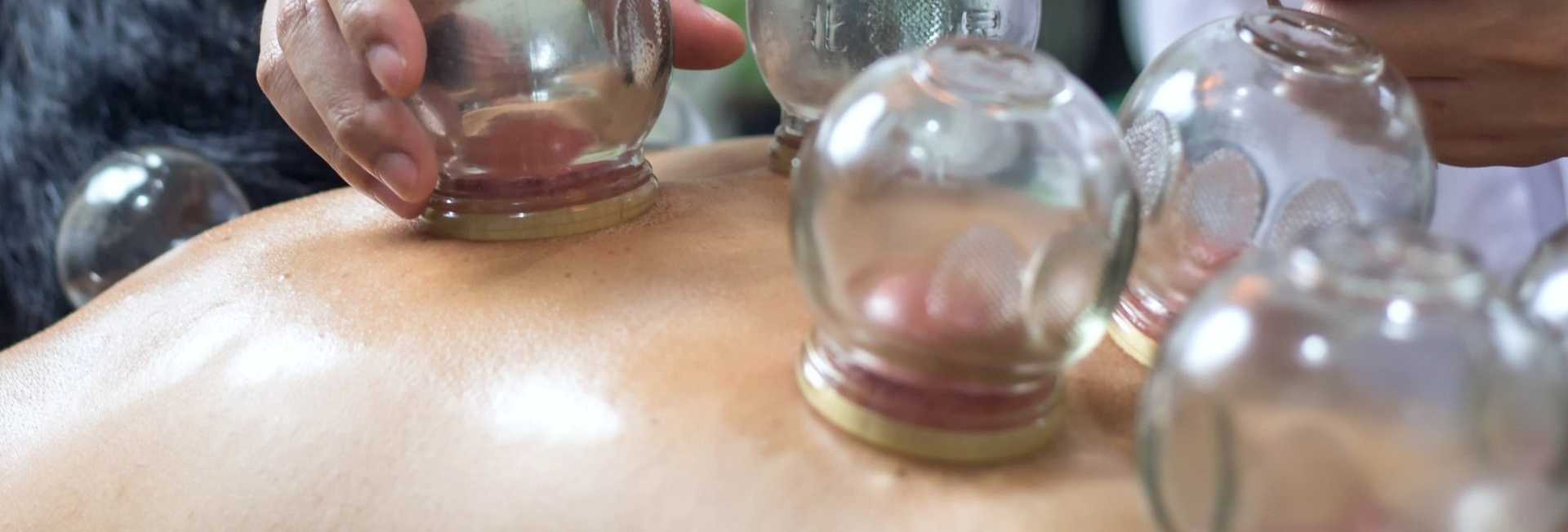 Dry cupping therapy