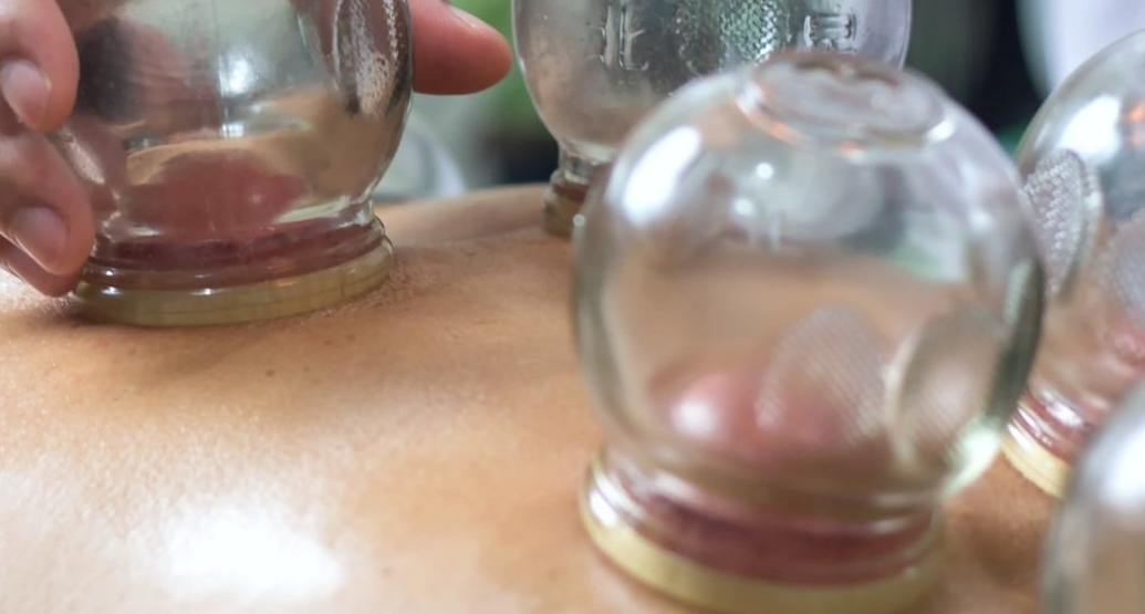 Dry cupping therapy