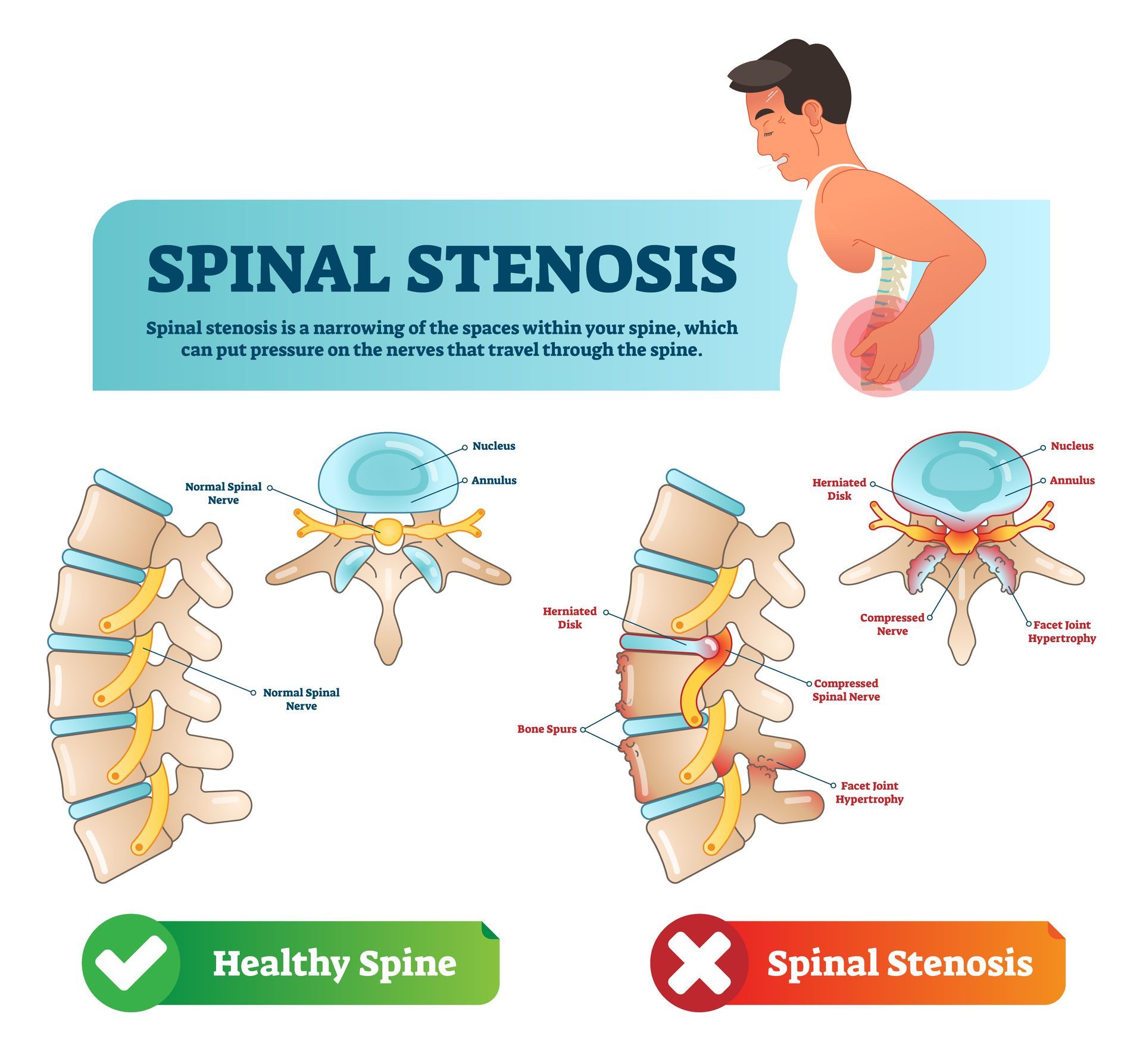 spine stenosis