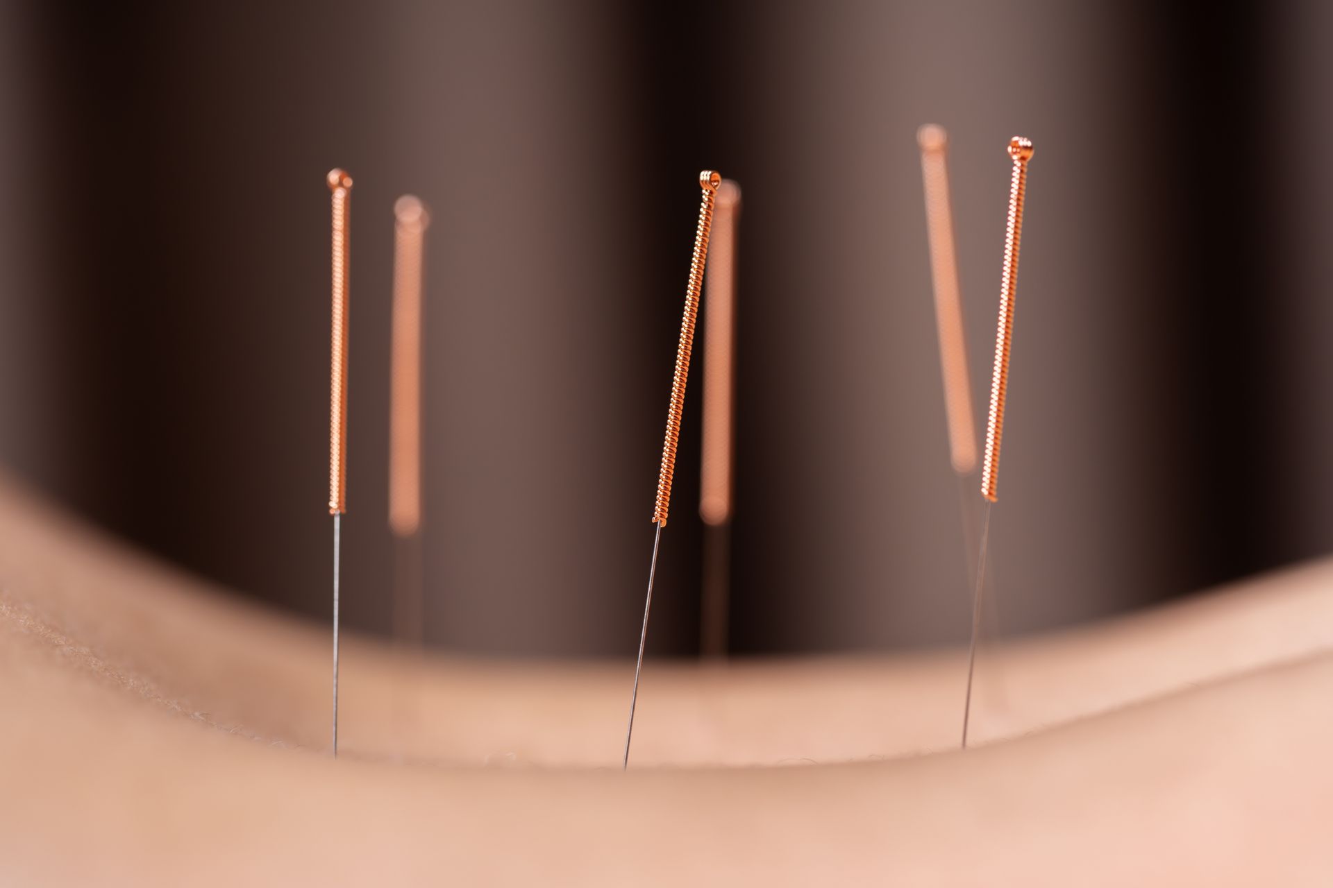 acupuncture