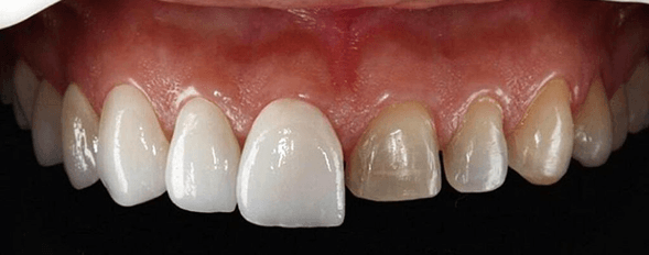 LAS CARILLAS DENTALES Y SU PRECIO