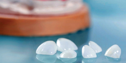 LAS CARILLAS DENTALES Y SU PRECIO