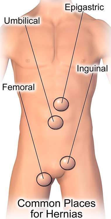 Diagram showing common locations of hernias on a man's abdomen: Epigastric, Umbilical, Inguinal, and Femoral — Endoscopist & General Surgeon in Mackay, QLD