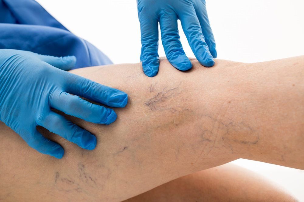 Checking Varicose Veins — Endoscopist & General Surgeon in Mackay, QLD