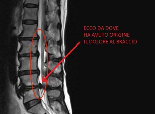 dolore al braccio spalla gomito