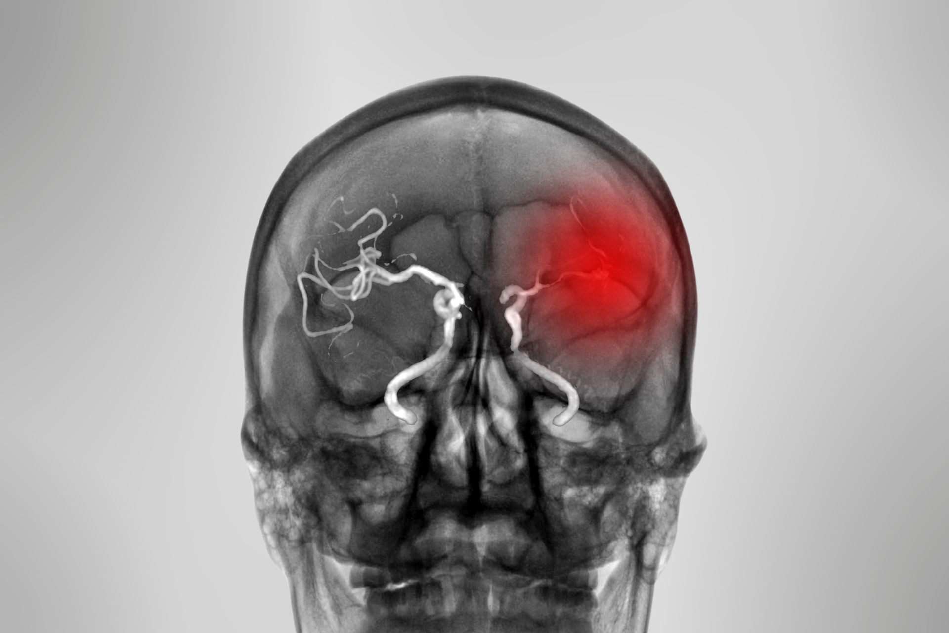 Untreated sleep apnea may lead to stroke. Are you at risk of having a stroke?