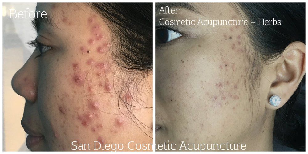 before and after of a woman's face, demonstrating reduction in acne after cosmetic acupuncture and herbs.