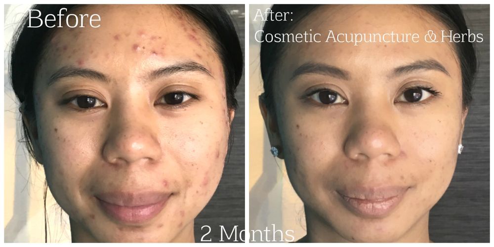 Before/after acne treatment: woman's face shows significant improvement after 2 months of cosmetic acupuncture/herbs.