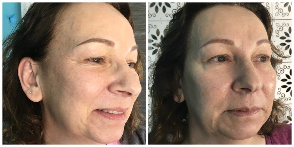 Side-by-side comparison of a woman's face, likely before and after a skincare treatment.