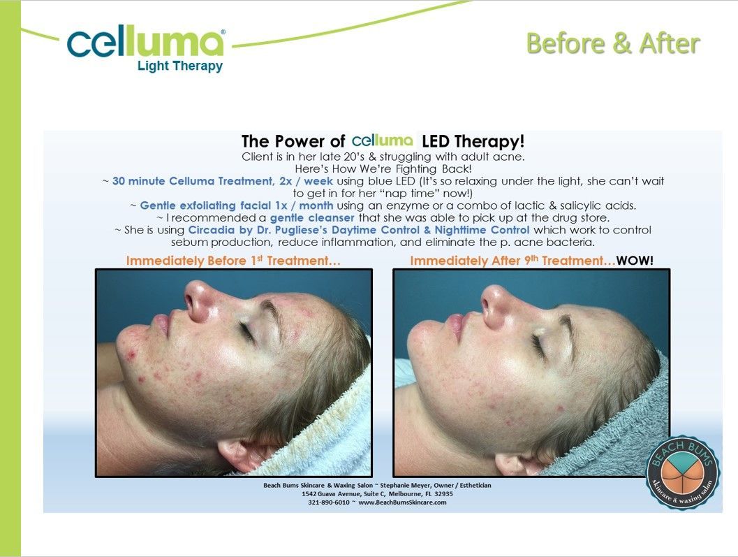 Side-by-side comparison showing acne treatment results. Before and after photos depict a woman with improved skin clarity.