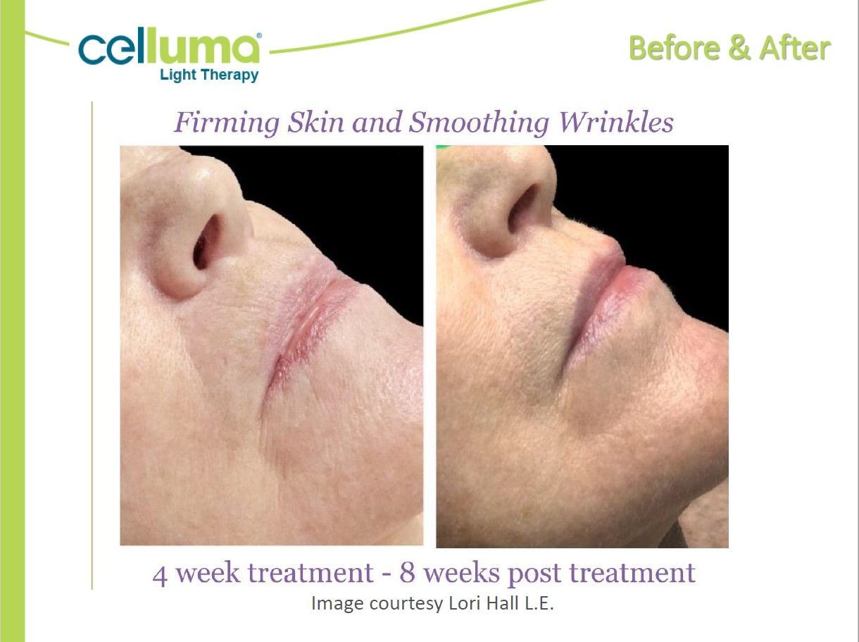 Before & After: Celluma light therapy results. Left, a face with a prominent wrinkle. Right, improved skin.