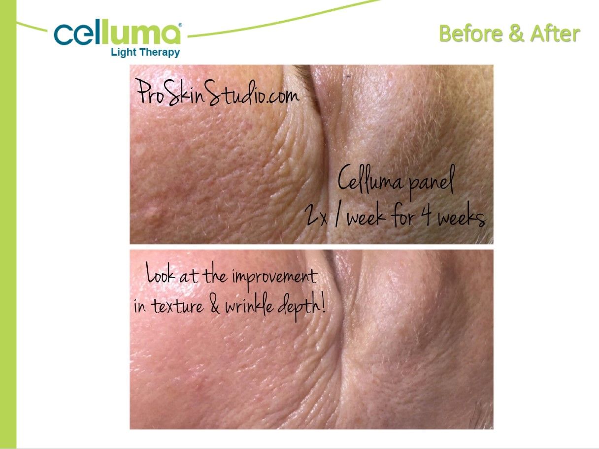 Before and after facial skin comparison, showing Celluma light therapy results.