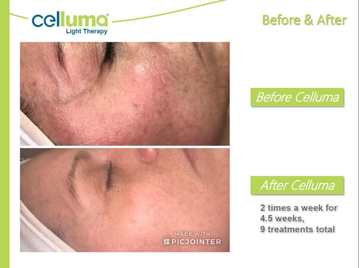 Before-and-after of face, Celluma light therapy reduces skin discoloration. Green borders indicate results.