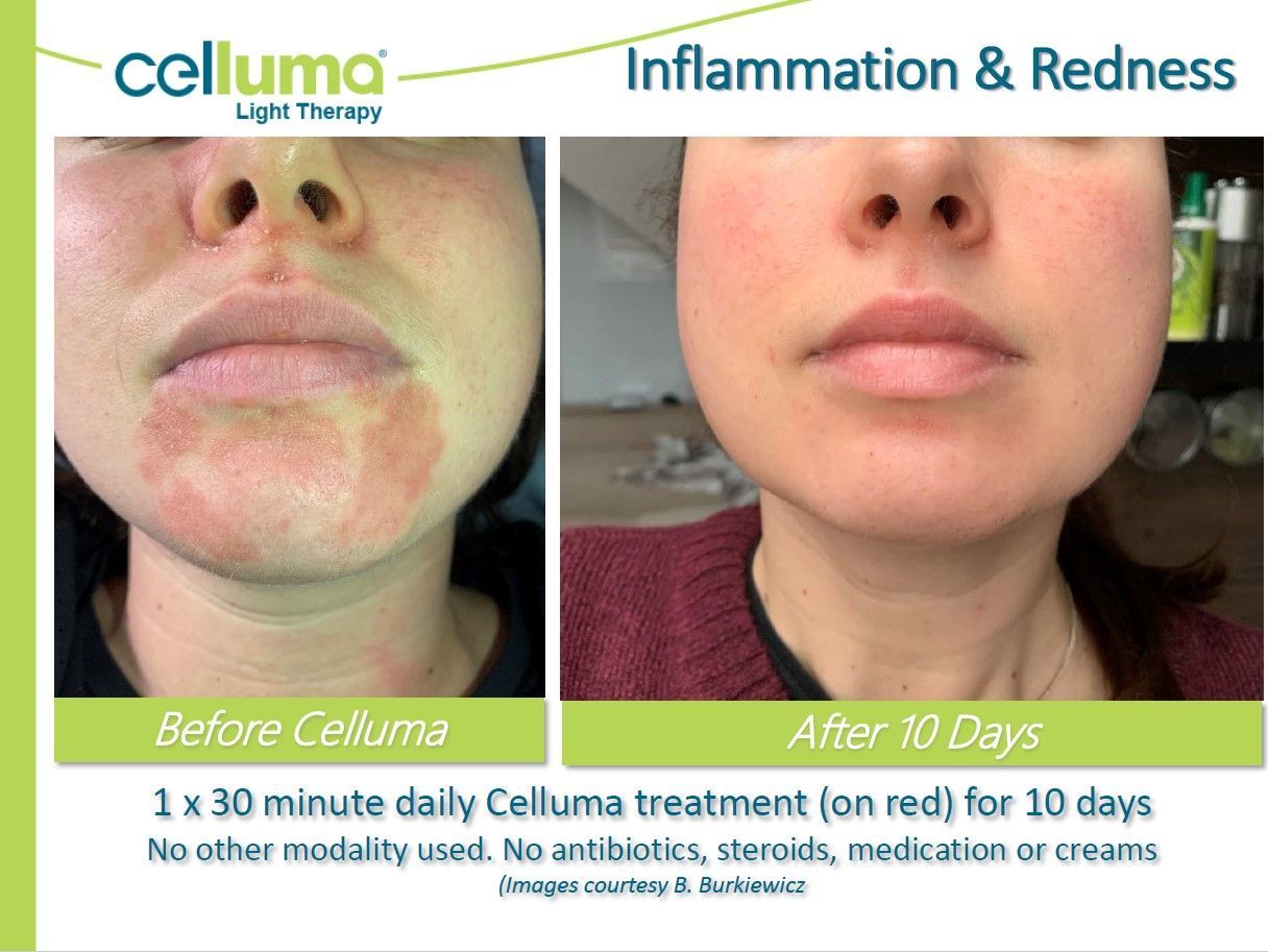 face with inflammation and redness 