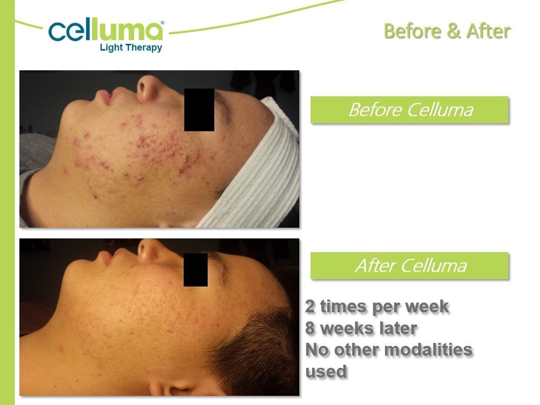 Before-and-after comparison of acne treatment using Celluma light therapy. Photos show improvement.