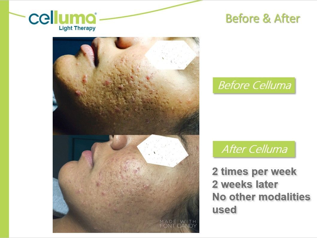 Comparison of acne skin before and after Celluma light therapy.