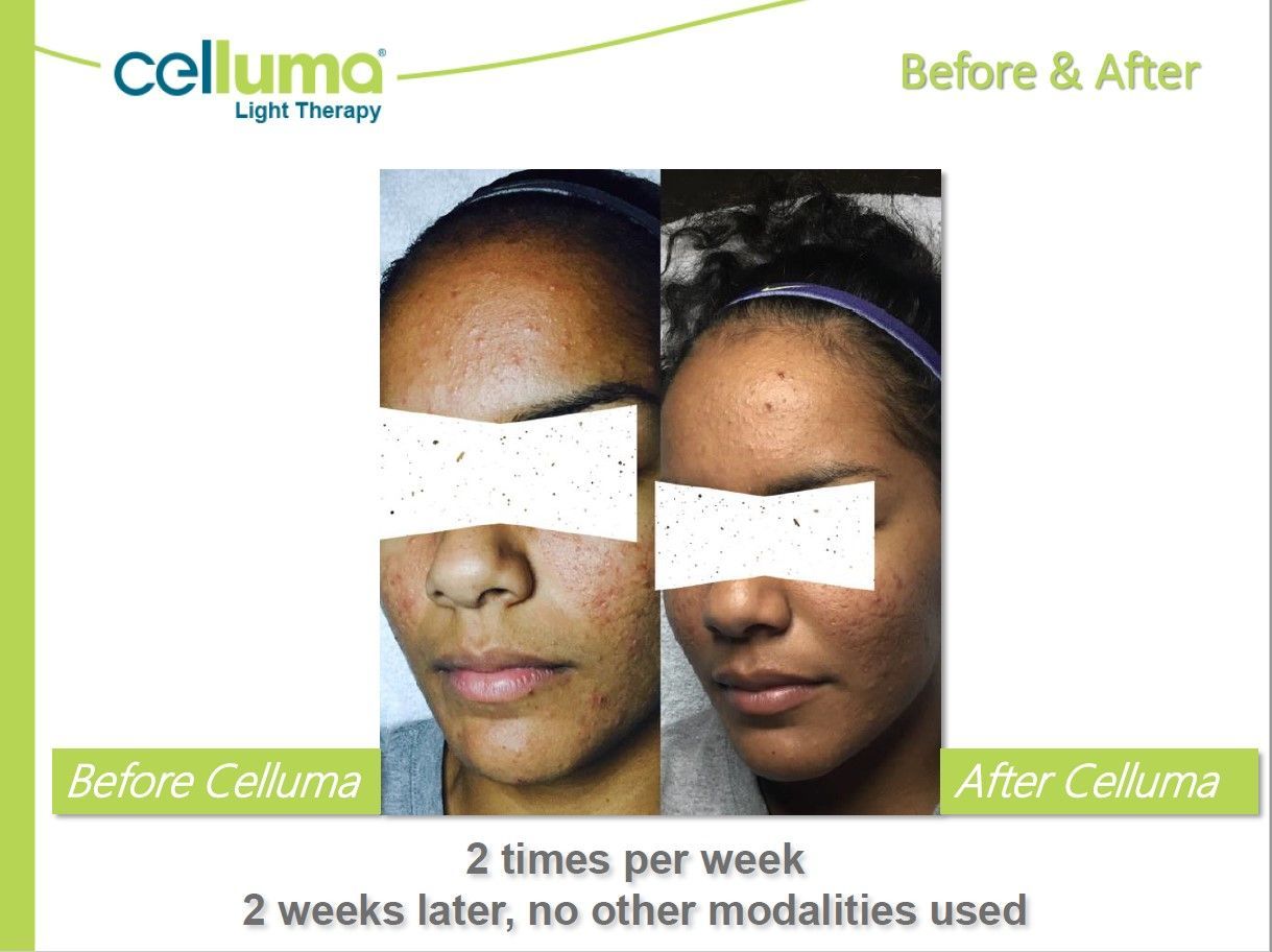 Side-by-side photos: woman's face before and after Celluma light therapy, showing reduced blemishes.