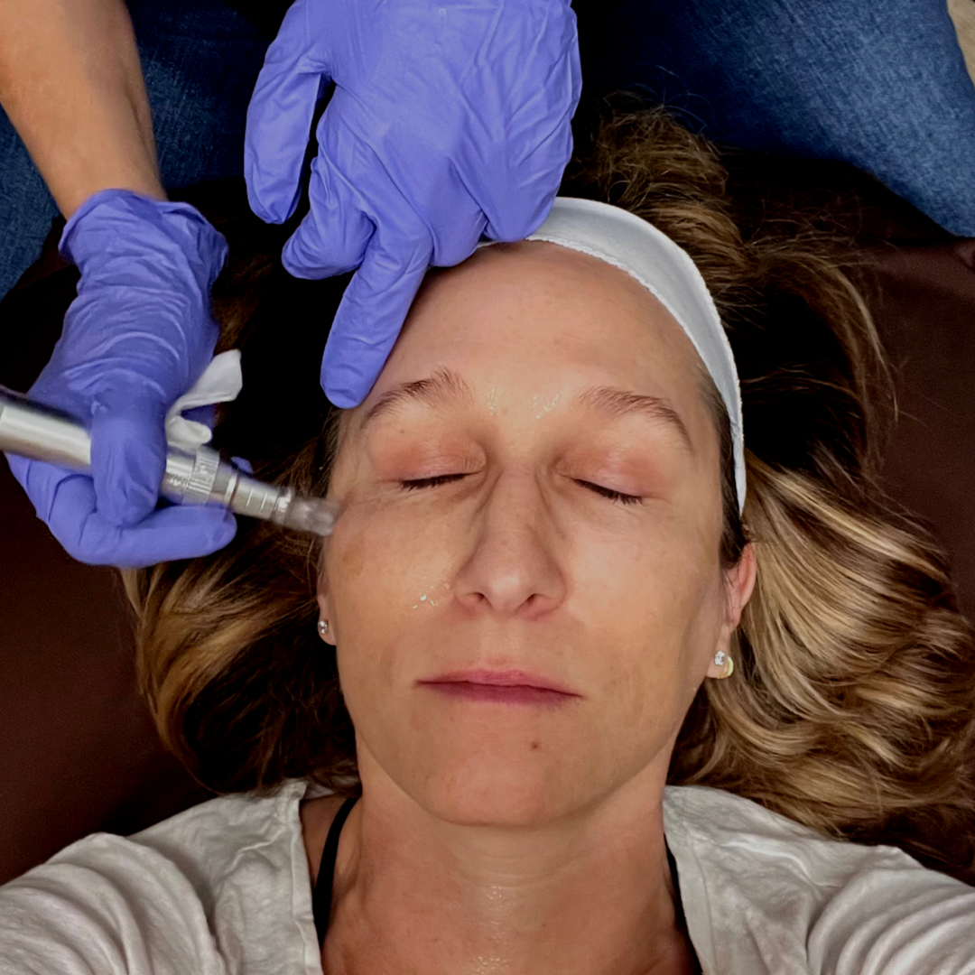 Woman receiving facial micro-needling treatment. Person in blue gloves holding device near face; eyes closed, headband on.