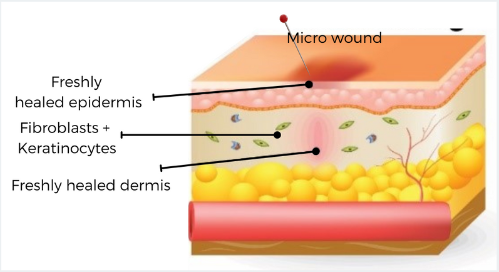 Cross-section of skin showing a micro wound, healed epidermis and dermis, with fibroblasts and keratinocytes.