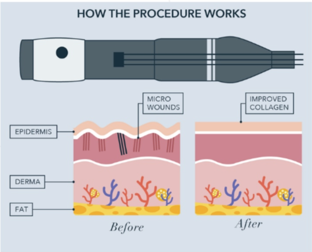 Diagram showing a skin microneedling device creating micro-wounds, then improving collagen.