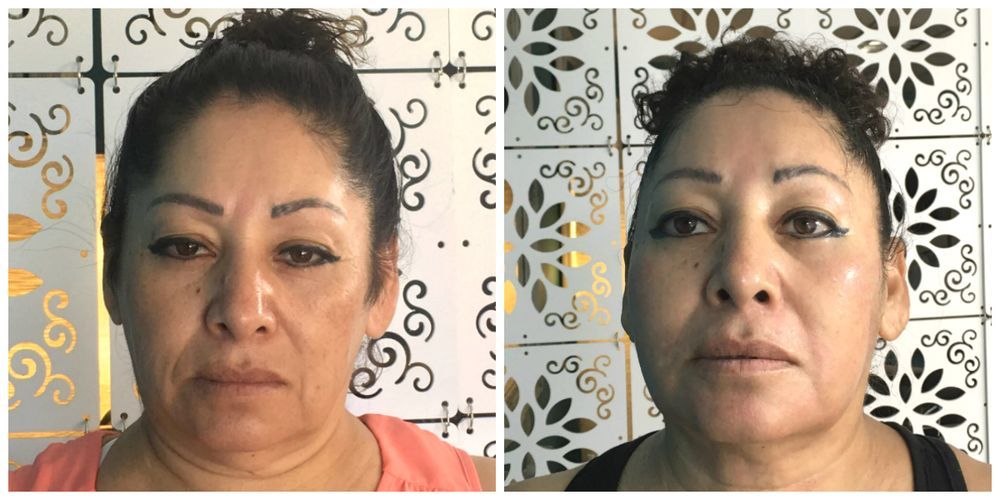 Side-by-side comparison of a woman's face, with improvements in her appearance, set against a patterned wall.