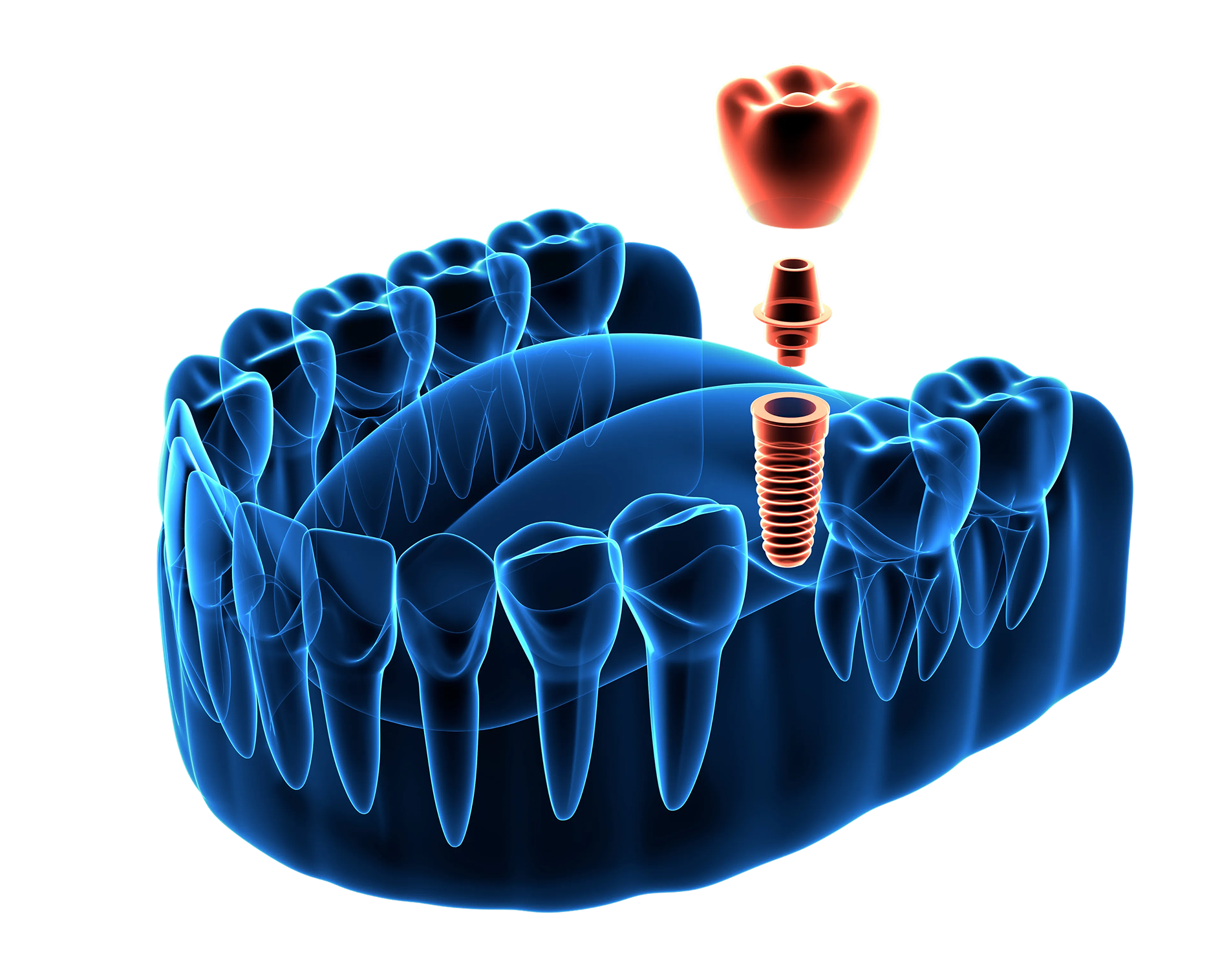 X-ray view of a jaw showing dental implant components: screw, connector, and crown.