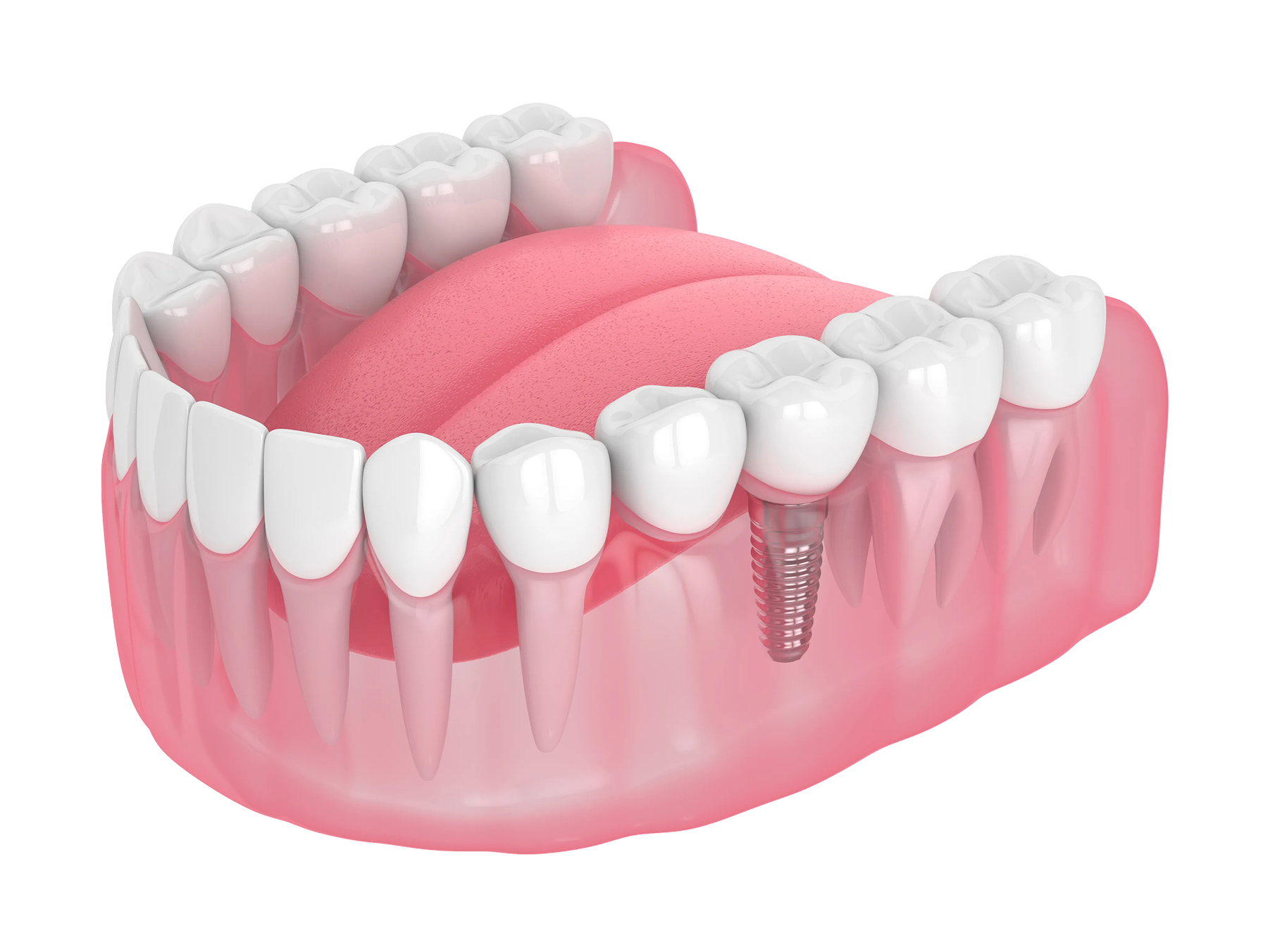 Model of a jaw with a dental implant, showing a screw embedded in the gums and a new tooth attached.
