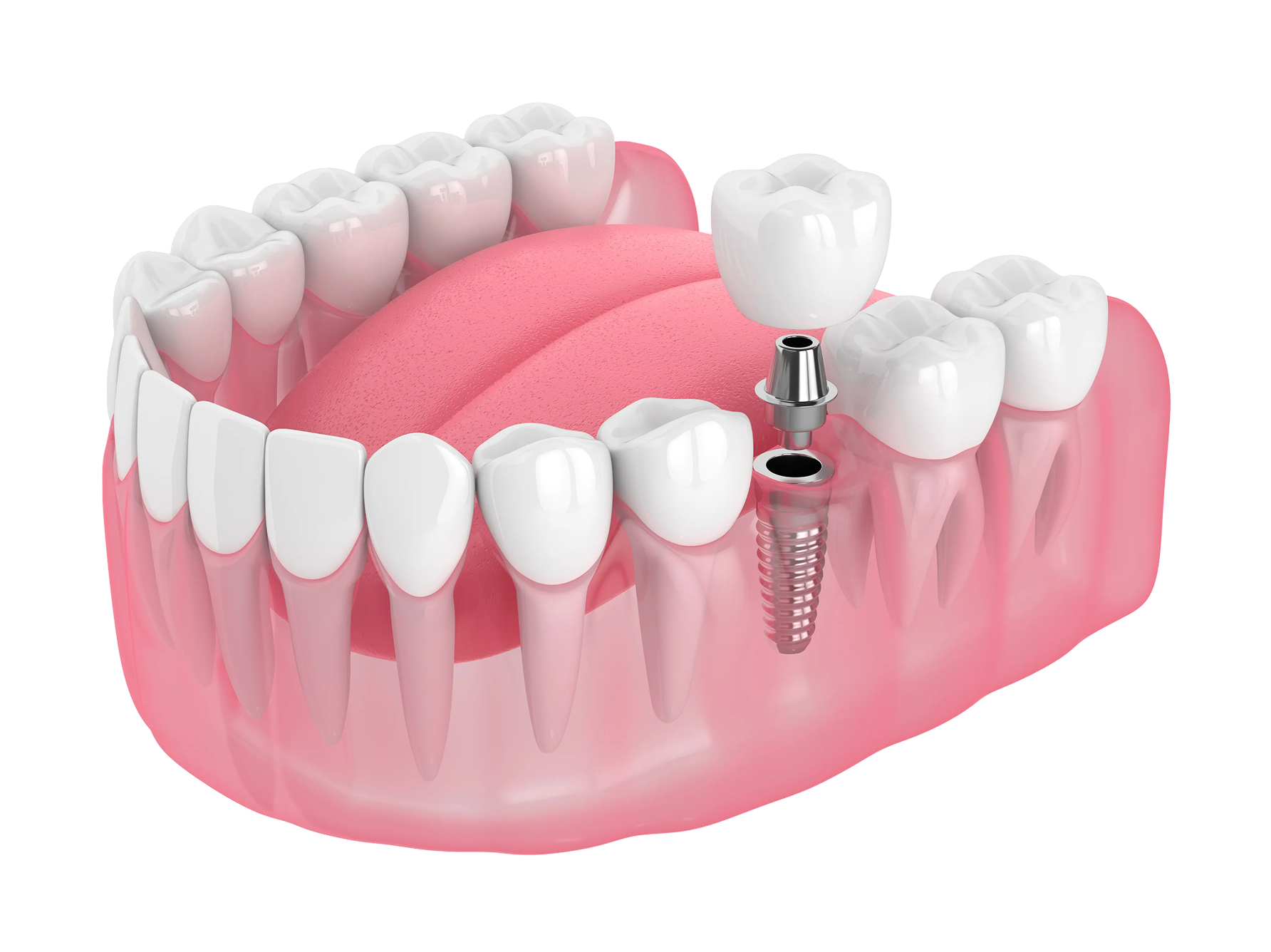 Dental model: shows a tooth implant with crown, other teeth, and pink gums.