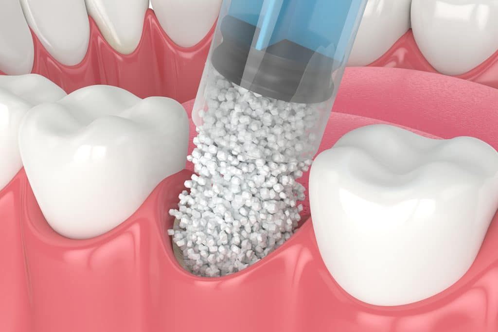 A dental syringe injects bone graft material into an empty socket between two human teeth.