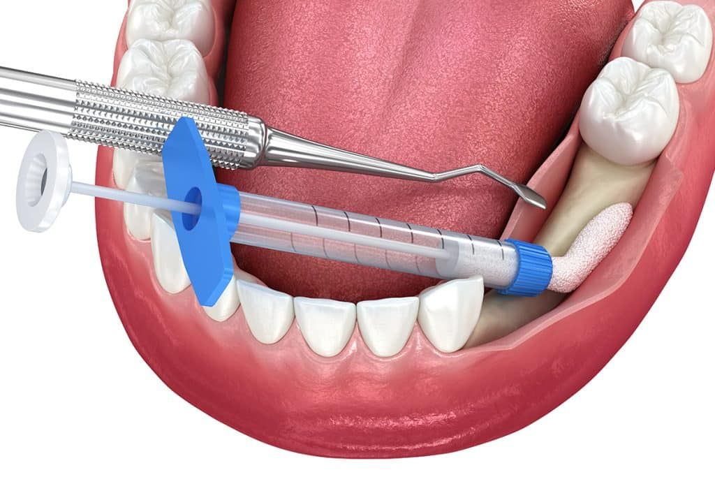 A dental tool and a syringe applying a gel treatment to the gum line near a lower molar.