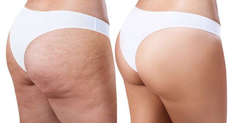 Confronto tra glutei prima e dopo: uno con cellulite visibile, uno liscio.