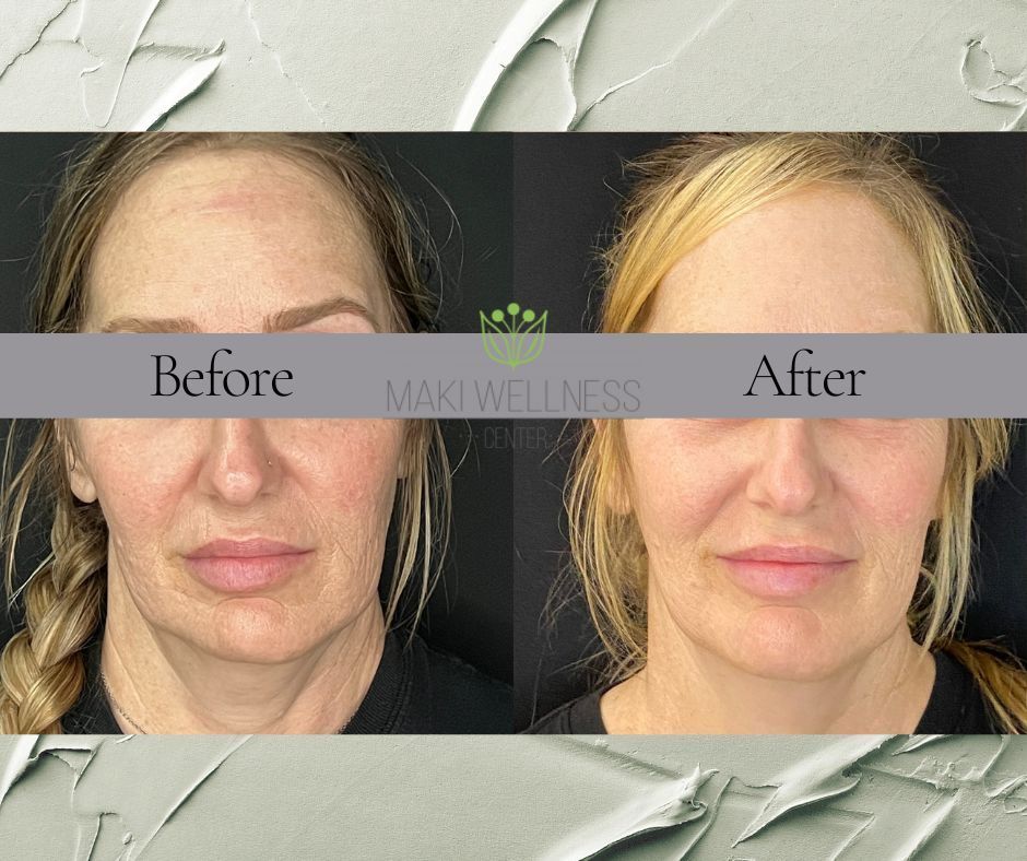 A before and after photo of a woman 's face.