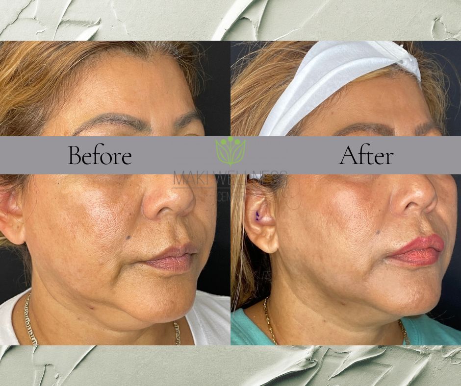 A before and after photo of a woman 's face