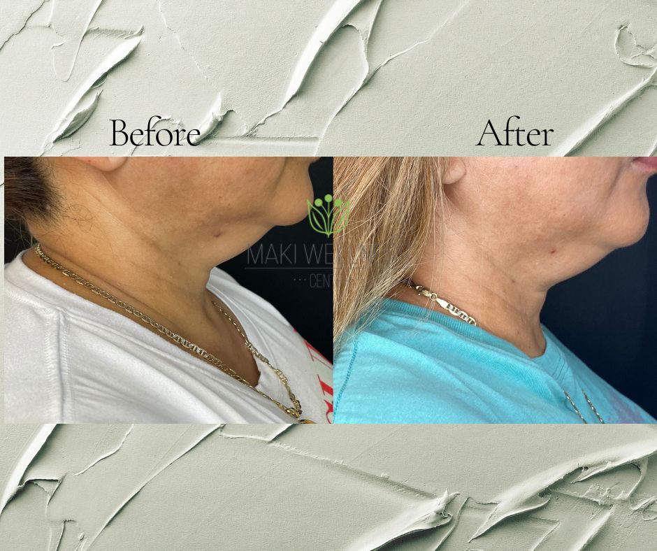 A before and after photo of a woman 's neck and neckline