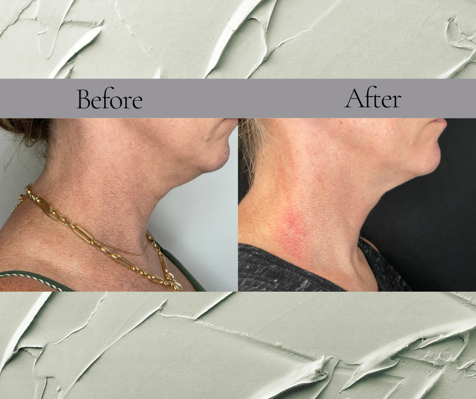 A before and after photo of a woman 's neck and neckline